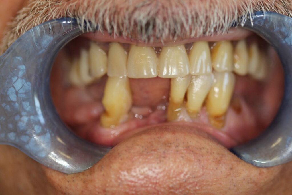 Implants and a Denture Preston